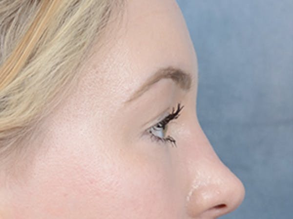 Eyelid Lift Before & After Gallery - Patient 121118824 - Image 9
