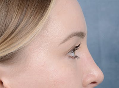 Eyelid Lift Before & After Gallery - Patient 121118824 - Image 10