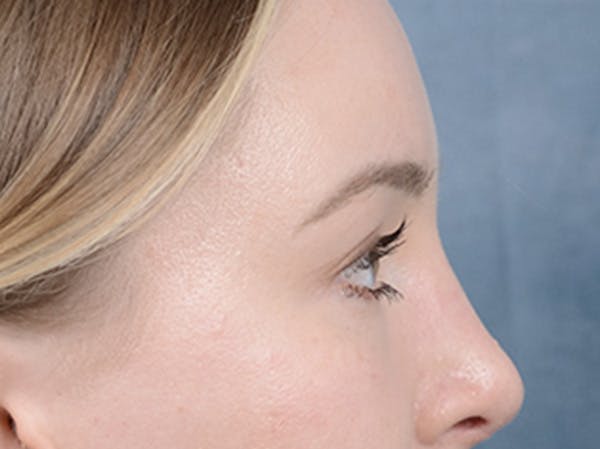 Eyelid Lift Before & After Gallery - Patient 121118824 - Image 10