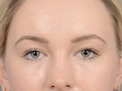Eyelid Lift Before & After Gallery - Patient 121118824 - Image 1