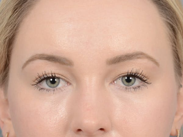 Eyelid Lift Before & After Gallery - Patient 121118824 - Image 1
