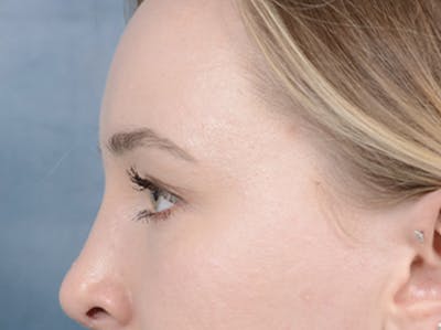 Eyelid Lift Before & After Gallery - Patient 121118824 - Image 6