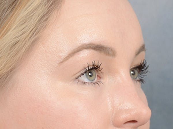 Eyelid Lift Before & After Gallery - Patient 121118824 - Image 7