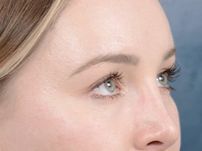 Eyelid Lift Before & After Gallery - Patient 121118824 - Image 8