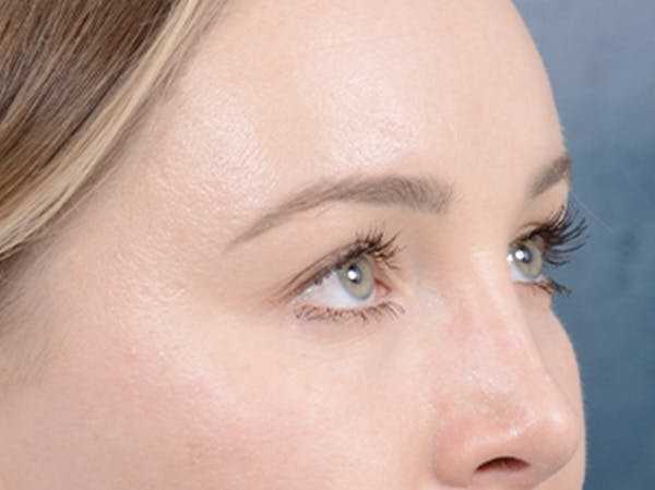 Eyelid Lift Before & After Gallery - Patient 121118824 - Image 8