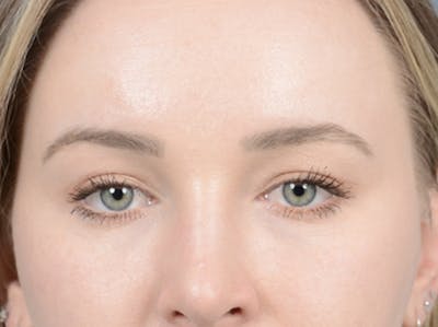 Eyelid Lift Before & After Gallery - Patient 121118824 - Image 2
