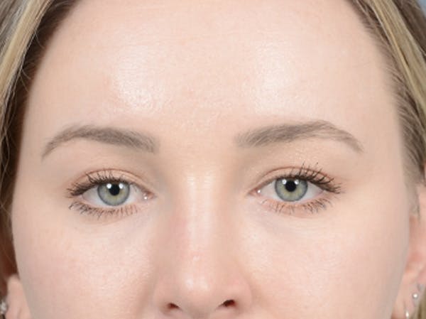 Eyelid Lift Before & After Gallery - Patient 121118824 - Image 2