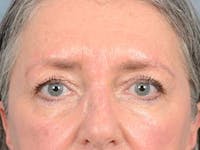 Eyelid Lift Before & After Gallery - Patient 121440636 - Image 1