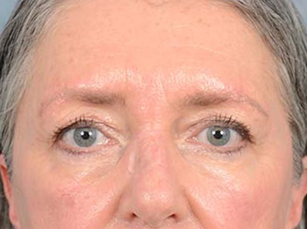 Eyelid Lift Before & After Gallery - Patient 121440636 - Image 1