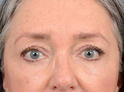 Eyelid Lift Before & After Gallery - Patient 121440636 - Image 2