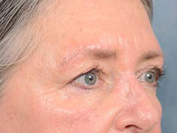 Eyelid Lift Before & After Gallery - Patient 121440636 - Image 3