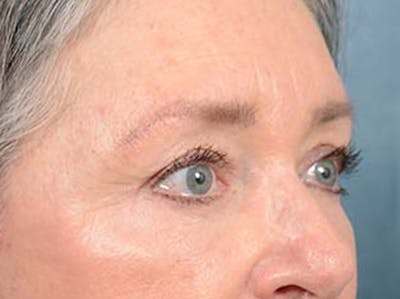 Eyelid Lift Before & After Gallery - Patient 121440636 - Image 4