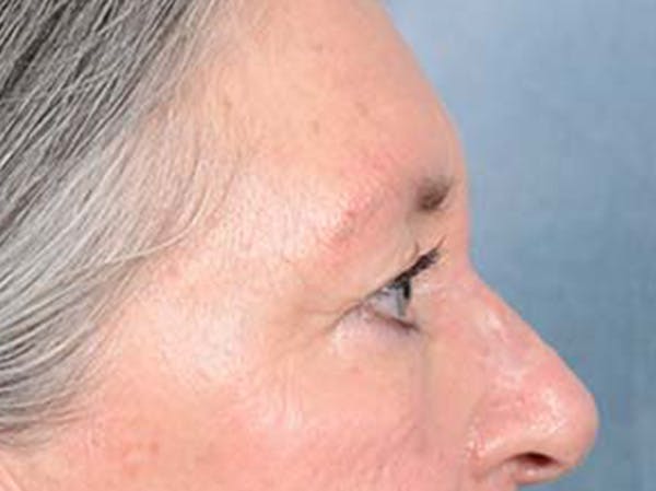 Eyelid Lift Before & After Gallery - Patient 121440636 - Image 5