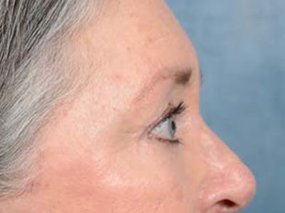 Eyelid Lift Before & After Gallery - Patient 121440636 - Image 6