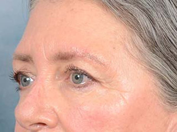 Eyelid Lift Before & After Gallery - Patient 121440636 - Image 7