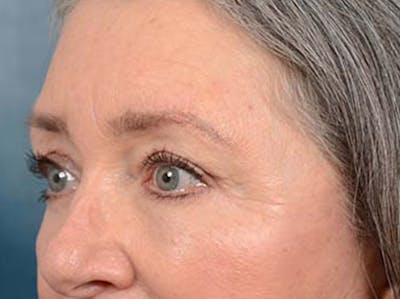 Eyelid Lift Before & After Gallery - Patient 121440636 - Image 8