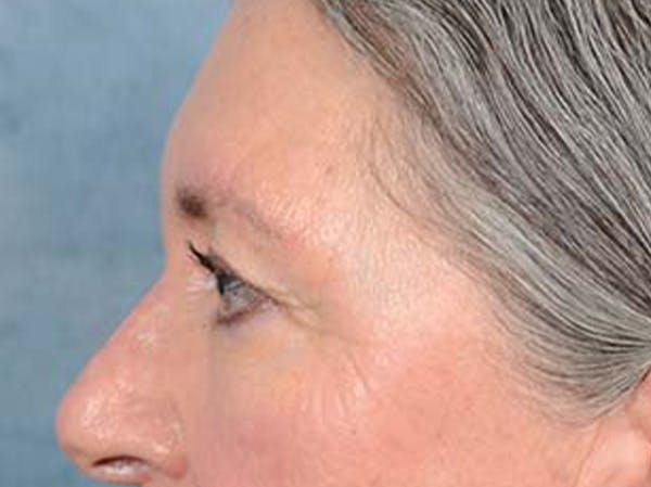 Eyelid Lift Before & After Gallery - Patient 121440636 - Image 9