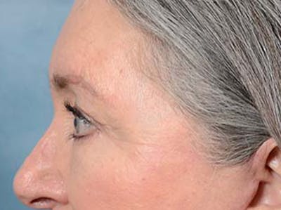 Eyelid Lift Before & After Gallery - Patient 121440636 - Image 10