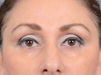 Eyelid Lift Before & After Gallery - Patient 121871729 - Image 1