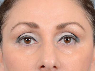 Eyelid Lift Before & After Gallery - Patient 121871729 - Image 1