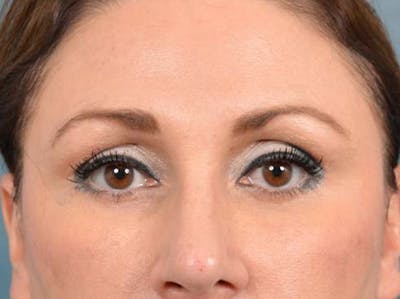 Eyelid Lift Before & After Gallery - Patient 121871729 - Image 2