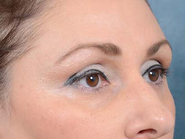 Eyelid Lift Before & After Gallery - Patient 121871729 - Image 3