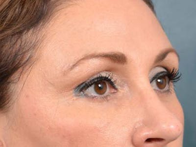 Eyelid Lift Before & After Gallery - Patient 121871729 - Image 4
