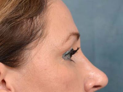 Eyelid Lift Before & After Gallery - Patient 121871729 - Image 6