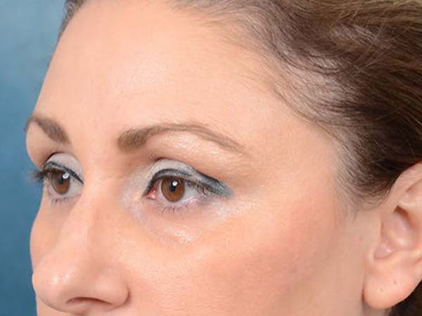 Eyelid Lift Before & After Gallery - Patient 121871729 - Image 7