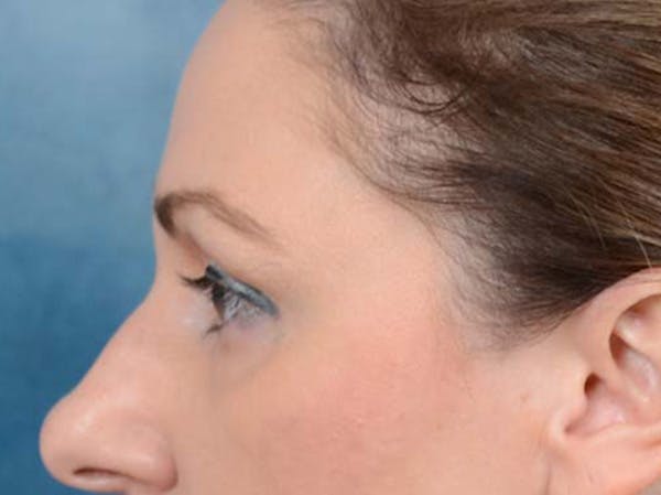 Eyelid Lift Before & After Gallery - Patient 121871729 - Image 9