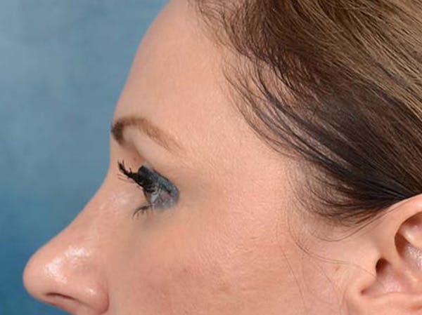 Eyelid Lift Before & After Gallery - Patient 121871729 - Image 10