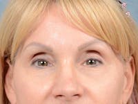 Eyelid Lift Before & After Gallery - Patient 121959676 - Image 1