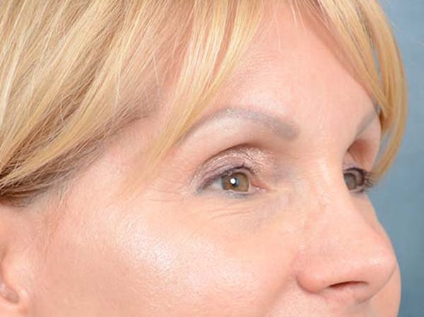 Eyelid Lift Before & After Gallery - Patient 121959676 - Image 3