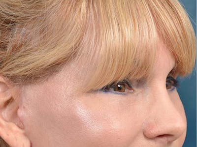 Eyelid Lift Before & After Gallery - Patient 121959676 - Image 4