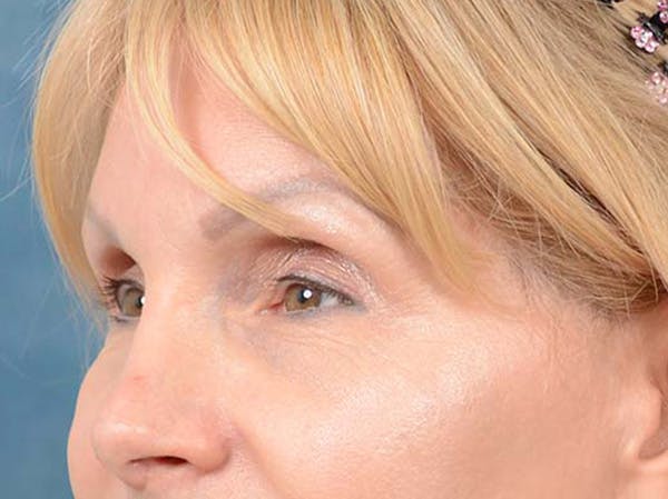 Eyelid Lift Before & After Gallery - Patient 121959676 - Image 7