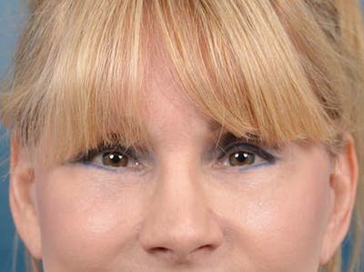Eyelid Lift Before & After Gallery - Patient 121959676 - Image 2
