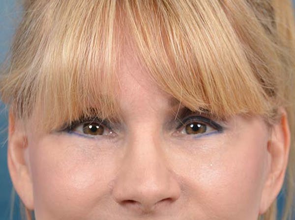 Eyelid Lift Before & After Gallery - Patient 121959676 - Image 2