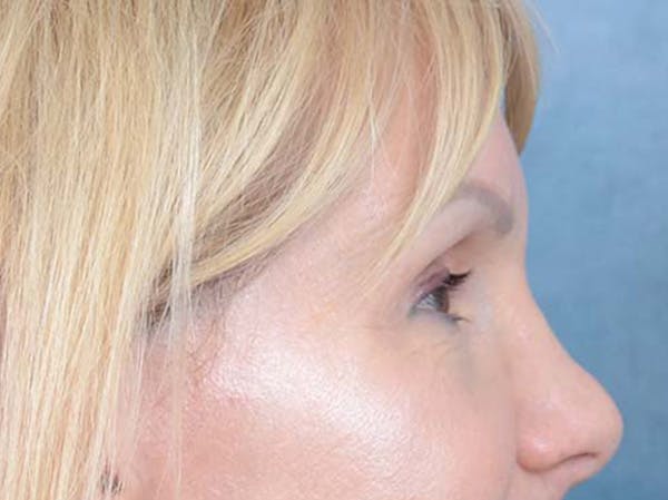 Eyelid Lift Before & After Gallery - Patient 121959676 - Image 5