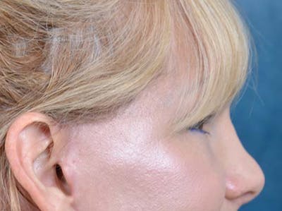 Eyelid Lift Before & After Gallery - Patient 121959676 - Image 6