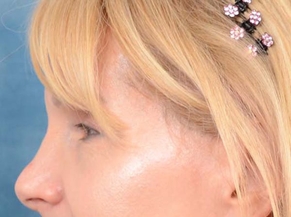Eyelid Lift Before & After Gallery - Patient 121959676 - Image 9