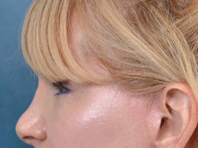 Eyelid Lift Before & After Gallery - Patient 121959676 - Image 10