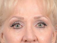 Eyelid Lift Before & After Gallery - Patient 122342675 - Image 1