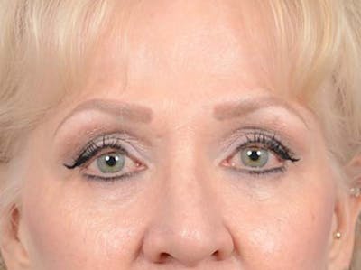 Eyelid Lift Before & After Gallery - Patient 122342675 - Image 1
