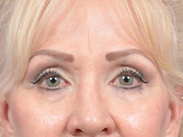 Eyelid Lift Before & After Gallery - Patient 122342675 - Image 2