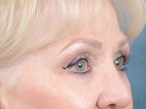 Eyelid Lift Before & After Gallery - Patient 122342675 - Image 3