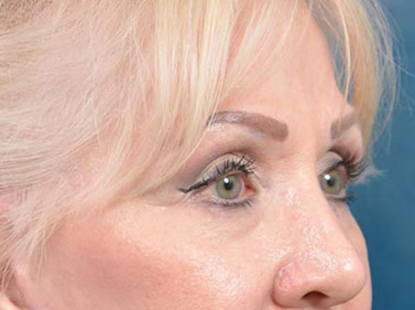 Eyelid Lift Before & After Gallery - Patient 122342675 - Image 4