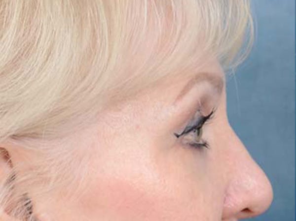 Eyelid Lift Before & After Gallery - Patient 122342675 - Image 5
