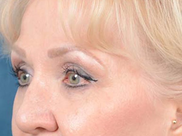 Eyelid Lift Before & After Gallery - Patient 122342675 - Image 7