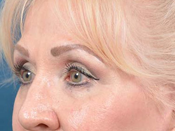 Eyelid Lift Before & After Gallery - Patient 122342675 - Image 8