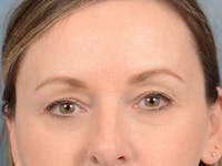Eyelid Lift Before & After Gallery - Patient 123090407 - Image 1
